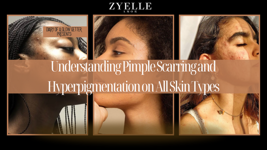 Understanding Pimple Scarring and Hyperpigmentation on All Skin Types